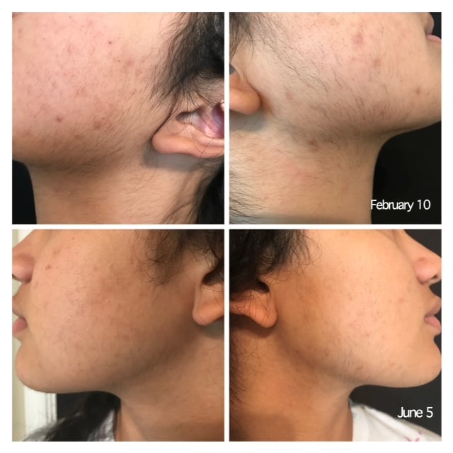 Smooth skin result after Nufree + Epilfree hair reduction