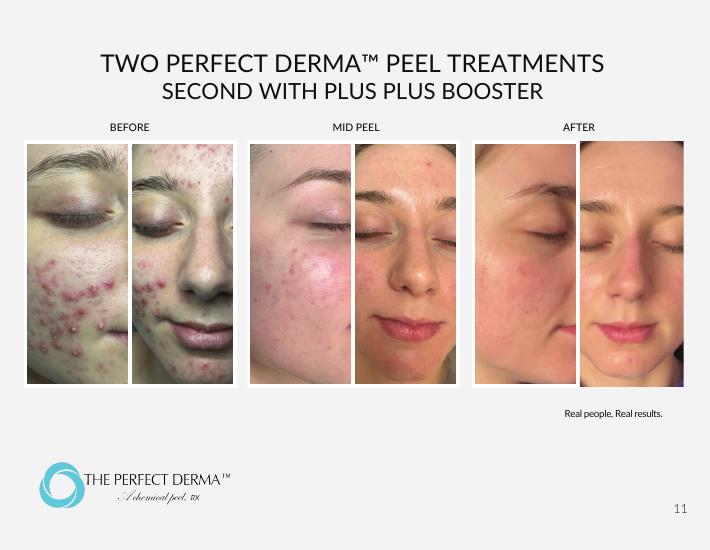 Perfect Derma Peel before, mid-peel, and after — documented clinical result
